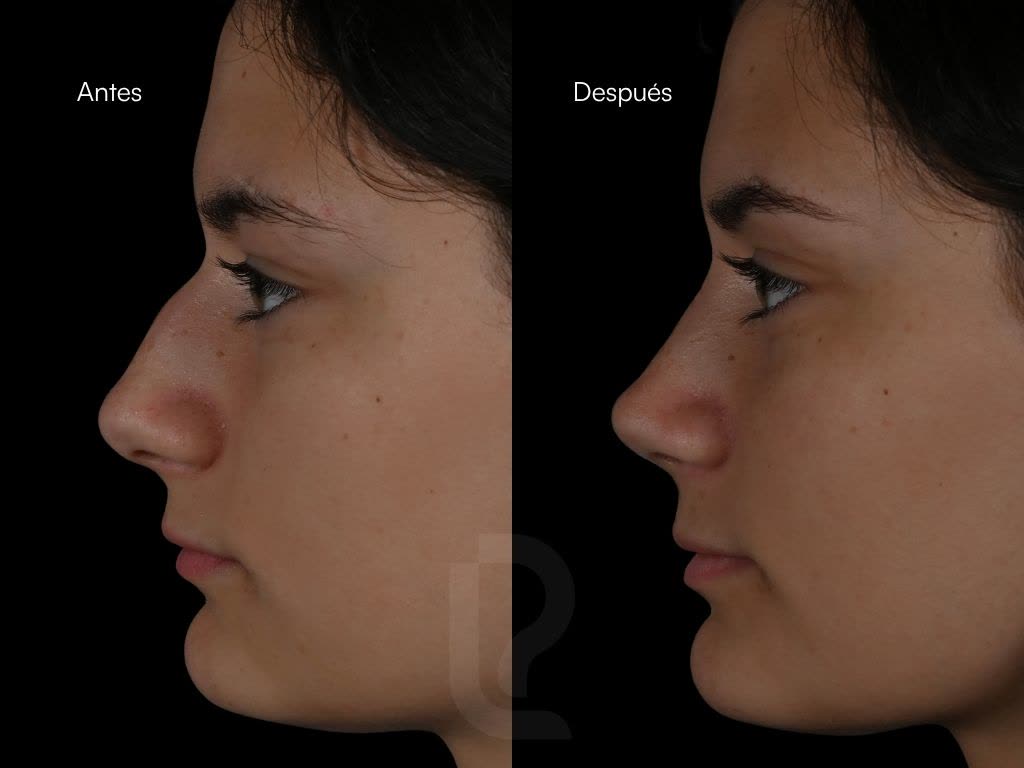 Rinoplastia caso 1
